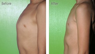 Pediatric patient before and after treatment of pectus carinatum