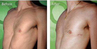 Before and after pectus excavatum surgical treatment