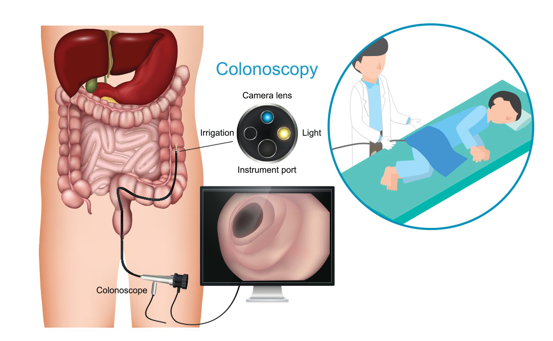 ilustración de colon, colonoscopio y el procedimiento.