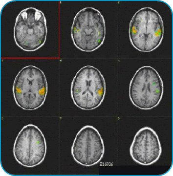 9 brain scans showing activity