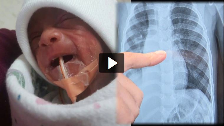 A split image of little Elijah with a feeding tube, next to an image of an x-ray