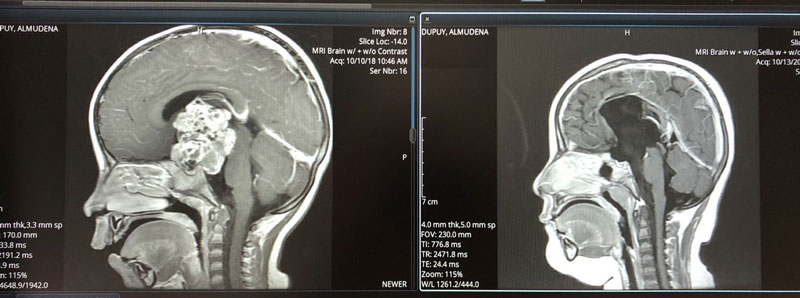 Left: Brain MRI before surgery. Right: One year after surgery.